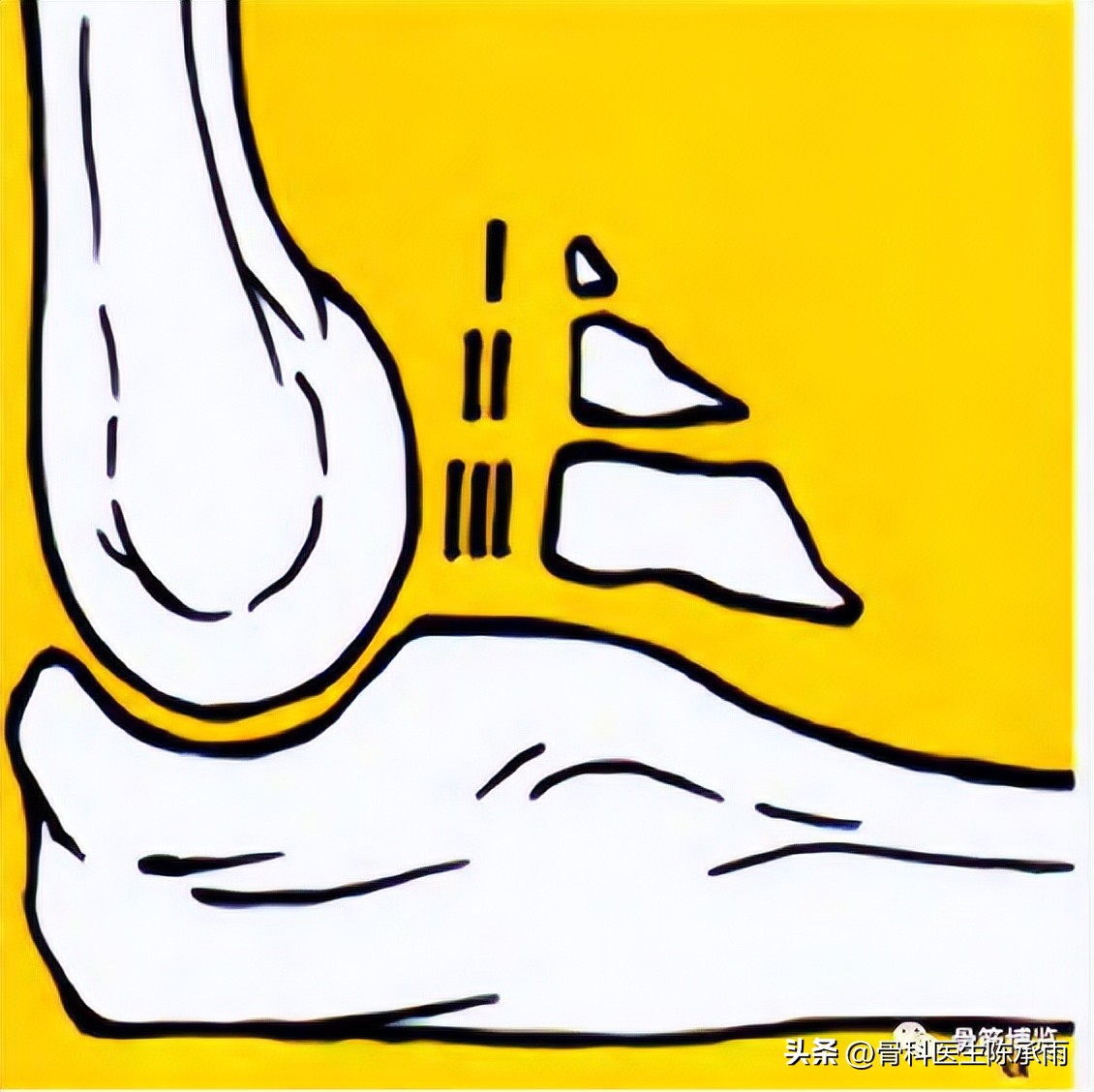 肘关节恐怖三联征最新治疗方法,肘关节恐怖三联征最佳治疗方法