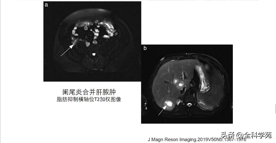 阑尾炎的讲解,关于阑尾炎的讨论总结