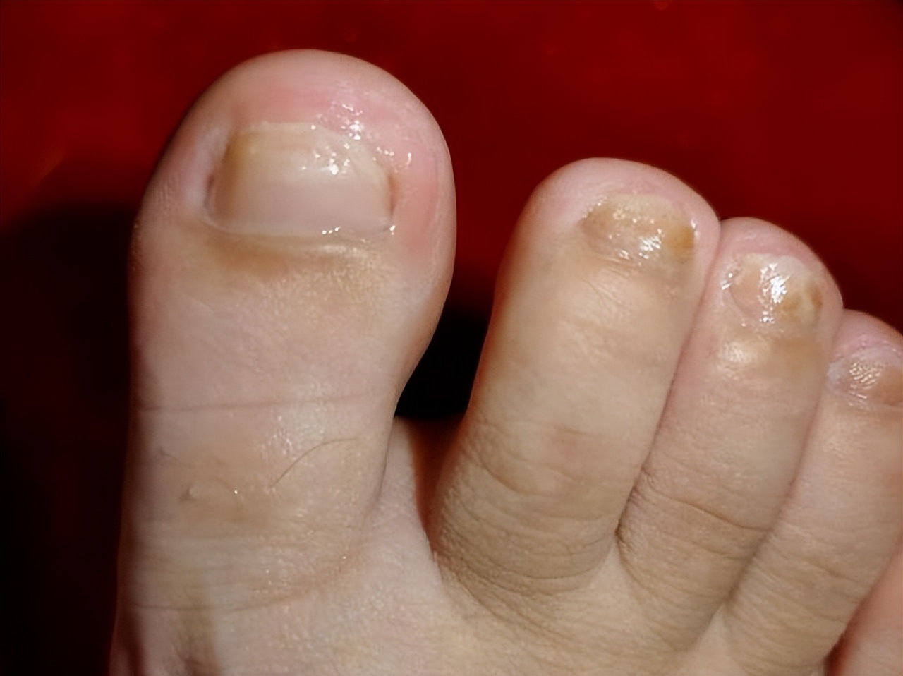 三招断根灰指甲,藿香正气水可以祛除灰指甲吗