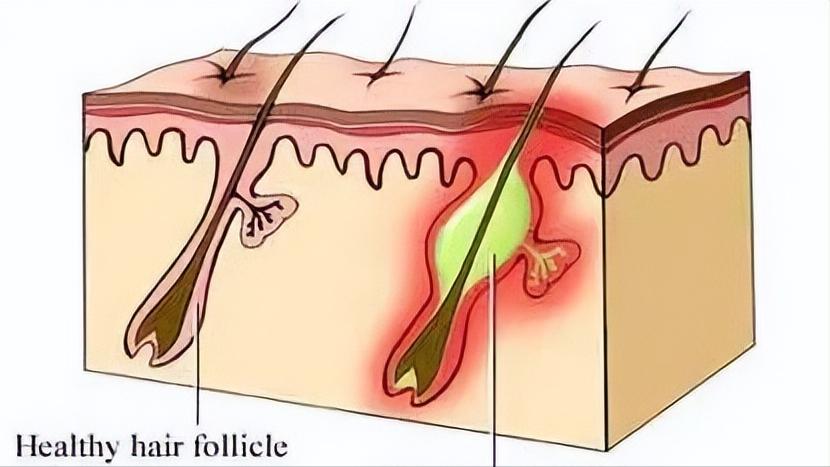 女性私部周围起痘什么原因,女性私部有痘痘