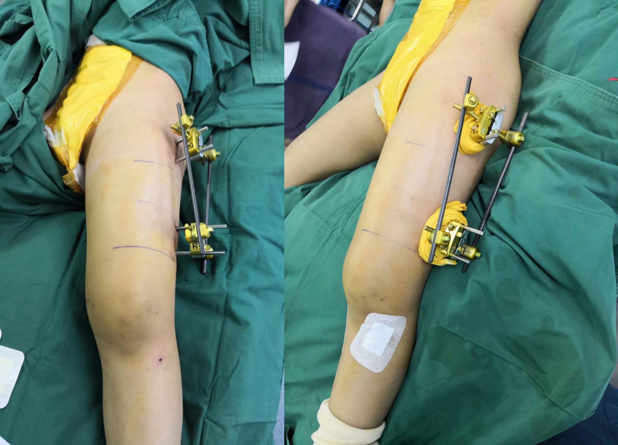 儿童股骨干粉碎性骨折对位不太好,儿童股骨干骨折石膏固定