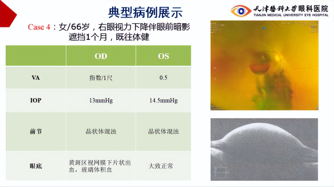 李筱荣教授,天津医科大学眼科医院李筱荣