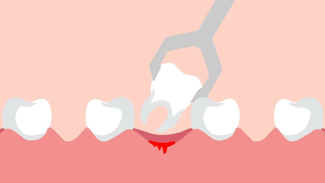 拔牙后持续疼痛需要吃消炎药吗,拔牙疼痛属于几级疼痛