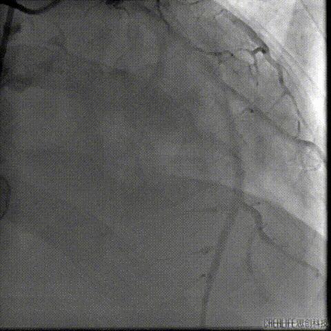 病例回顾与分享,腹膜后血肿介入治疗
