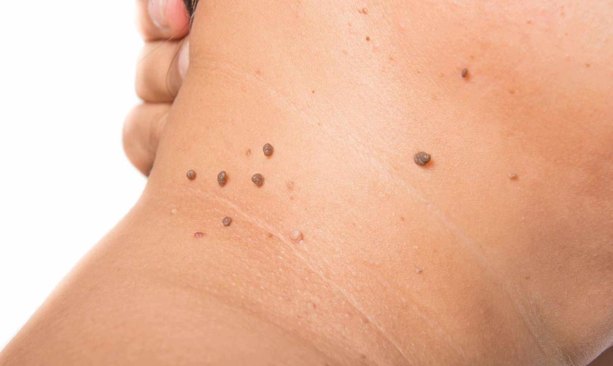 脖子上和腋下的小肉粒是什么原因,颈部和腋窝有小肉粒怎么消除