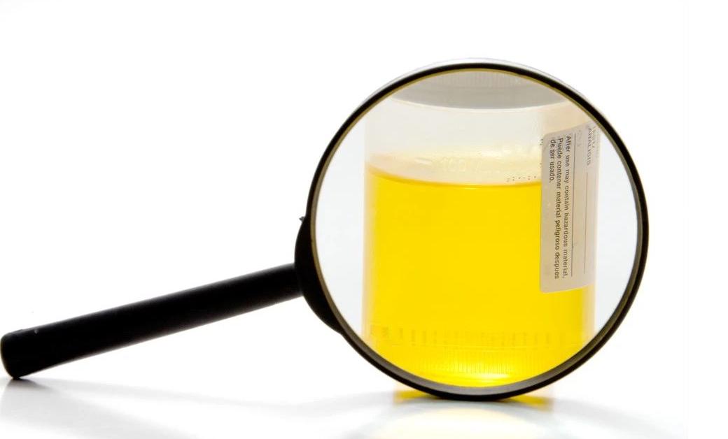 男性尿液有泡沫就是肾出了问题吗,小便有细小泡沫肾没问题怎么回事