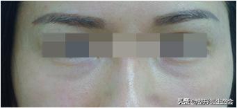 淡化泪沟有什么小技巧和方法,泪沟越来越明显是什么原因