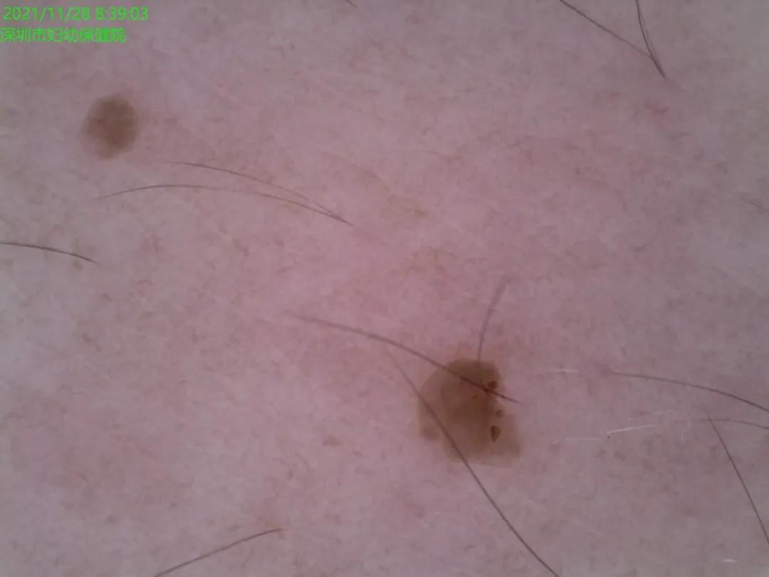 怀孕后脖子上长丝状疣以后会掉吗,怀孕脖子上长了好多小疹子