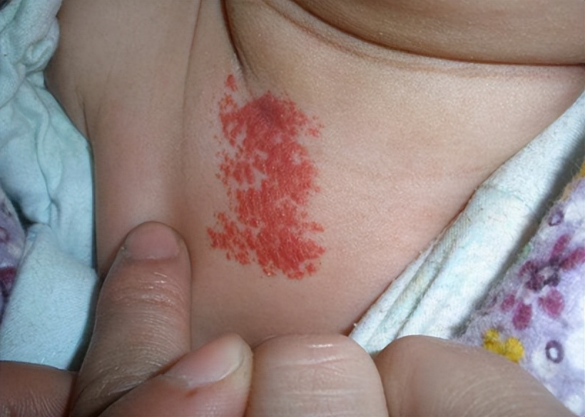 宝宝手部血管瘤家长注意观察,家长不可不知的血管瘤常识