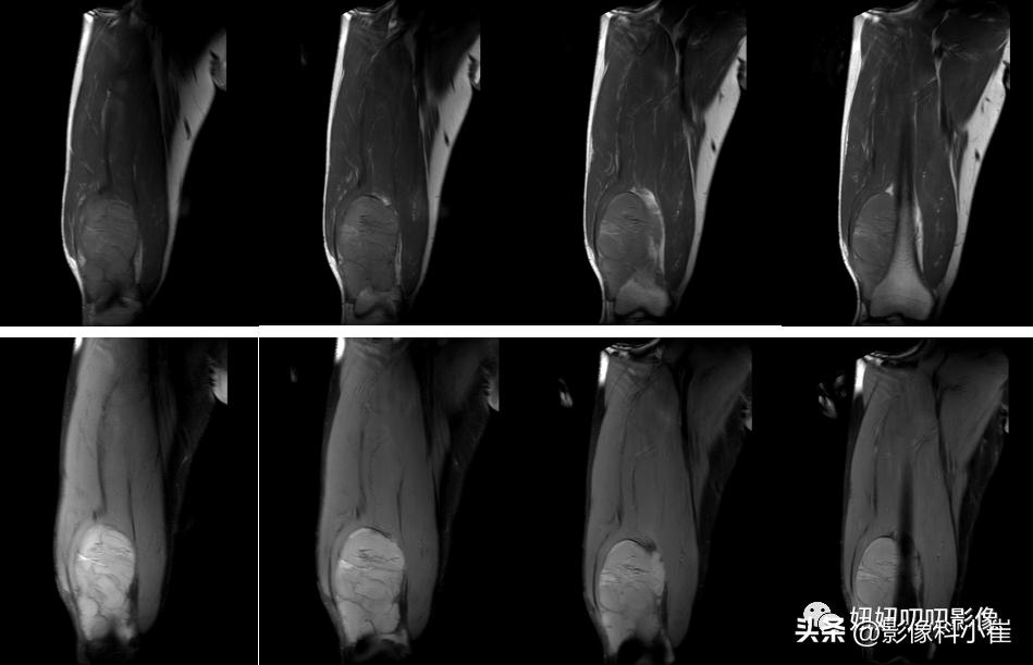 软组织肿块形成原因,软组织肿块怎么治最好