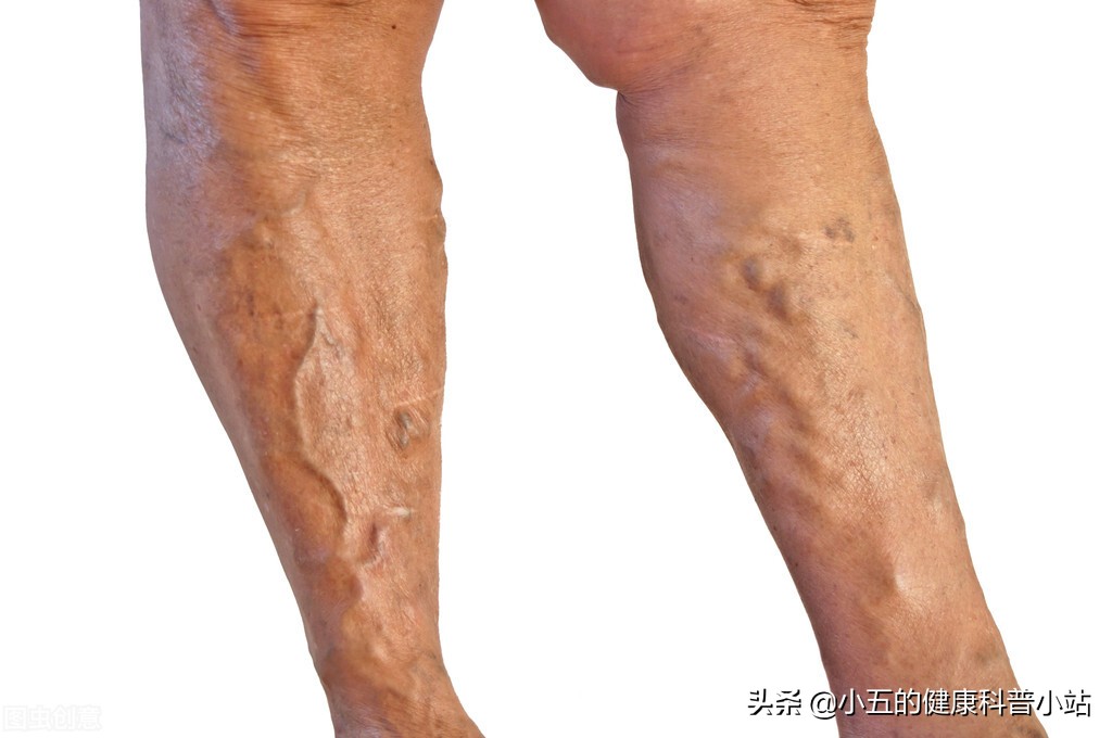 下肢静脉曲张药物,老年人下肢静脉曲张怎么治疗最好