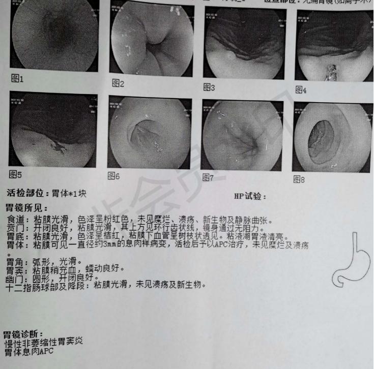 胃多发息肉是割还是中医调理,慢性胃炎伴多发息肉如何养护