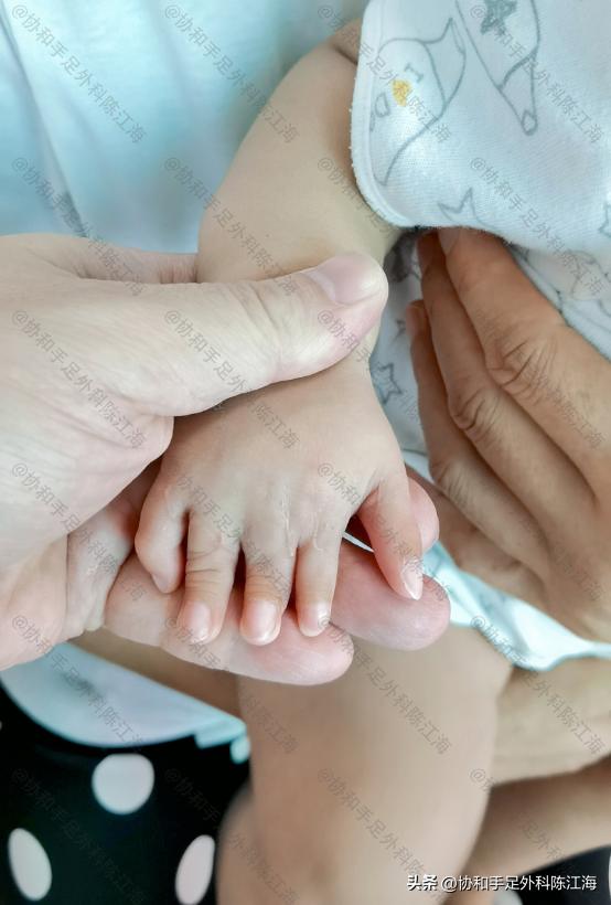 宝宝手指先天性畸形是什么原因,宝宝手指畸形短指怎么办