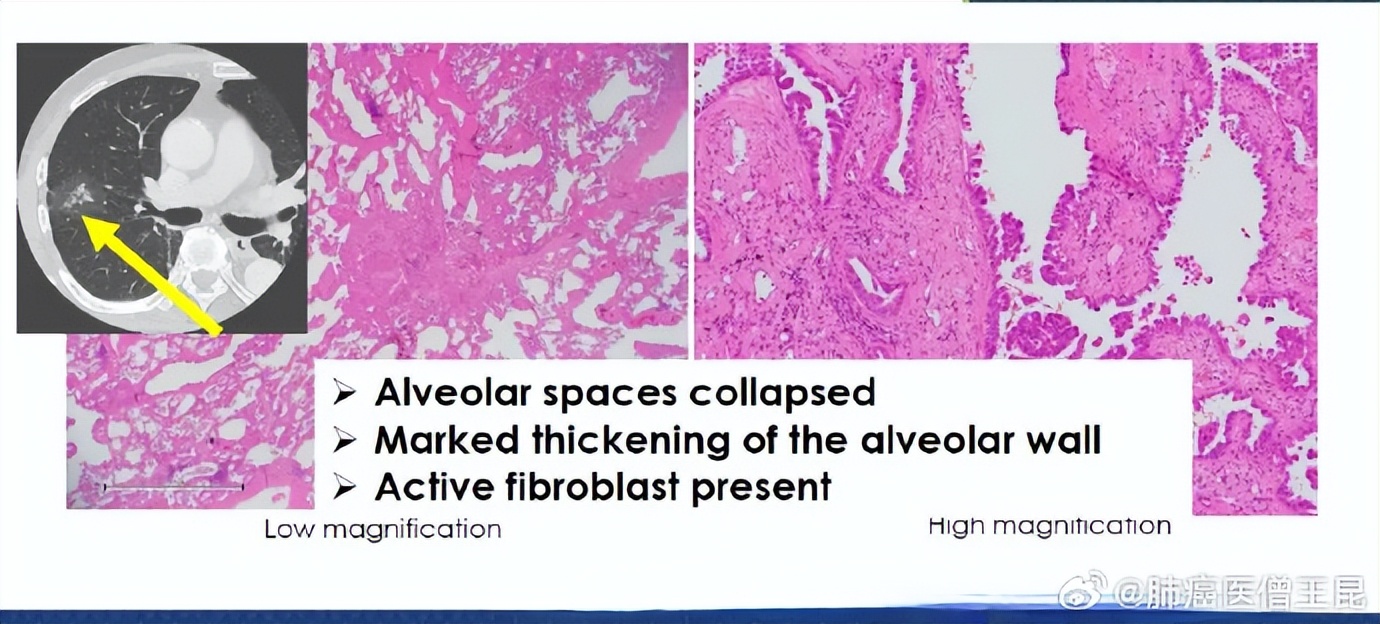 肺磨玻璃结节(GGO)最佳处理策略——东西方观点