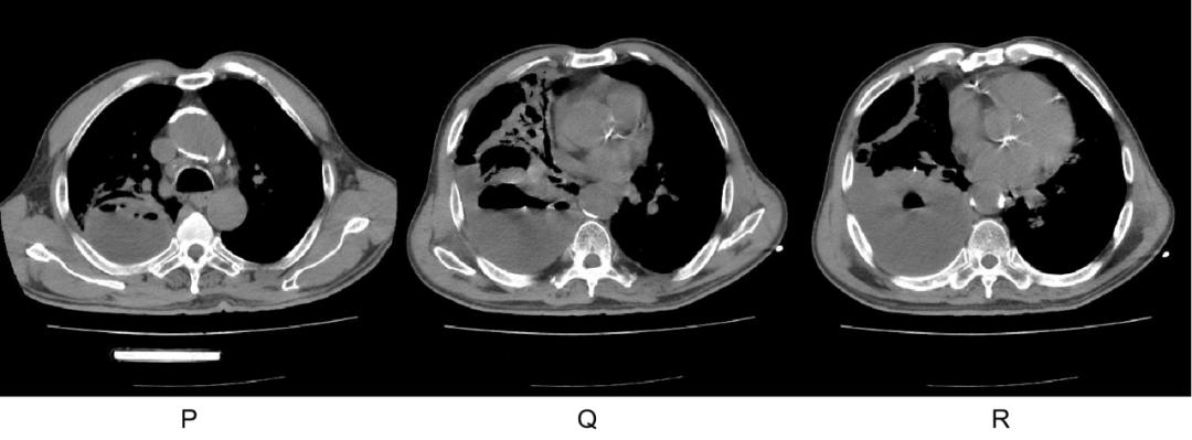 mrsa用什么药,mrsa对哪些药物敏感