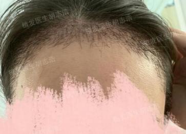 植发后后枕部的头发多久能恢复,植发3个月恢复图片