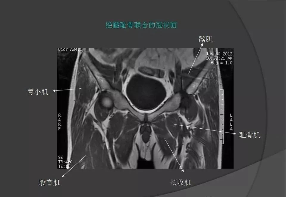 女性盆腔ct连续断层解剖图,盆腔mri影像病例分析