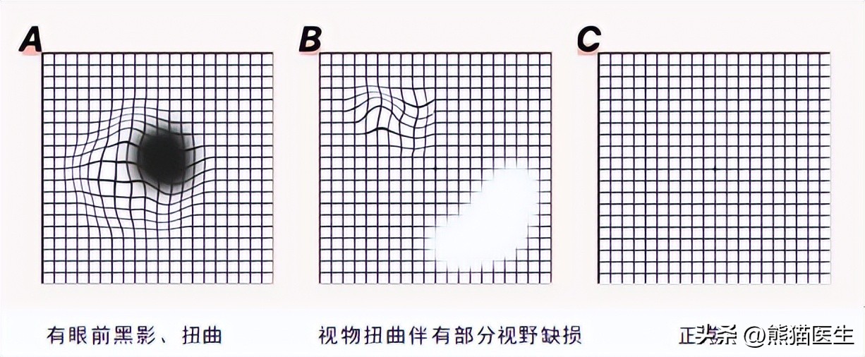 阳了一周之后眼睛模糊是后遗症吗,阳后出现眼部症状会怎样