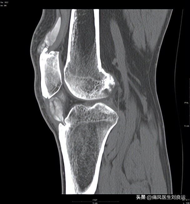 急性痛风吃秋水仙碱配什么,痛风吃秋水仙碱和非布司他的方法