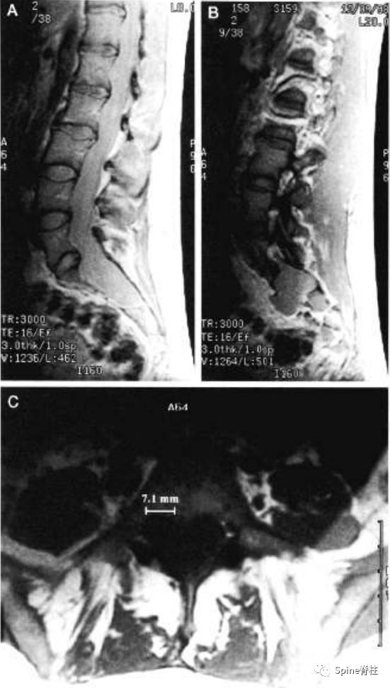 硬膜囊扩张是什么意思,硬膜囊扩张压迫神经