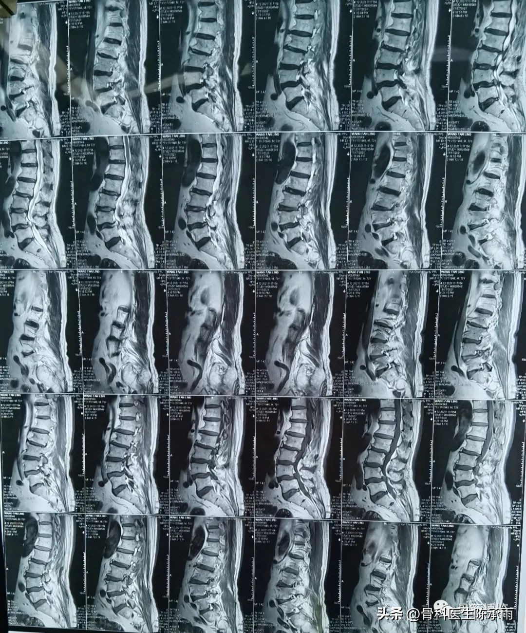 腰椎滑脱椎管狭窄手术后遗症,腰椎间盘突出椎管狭窄的手术