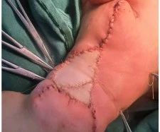 婴儿脑动脉瘤破裂开颅手术成功率,宝宝身上的血管瘤终于手术成功