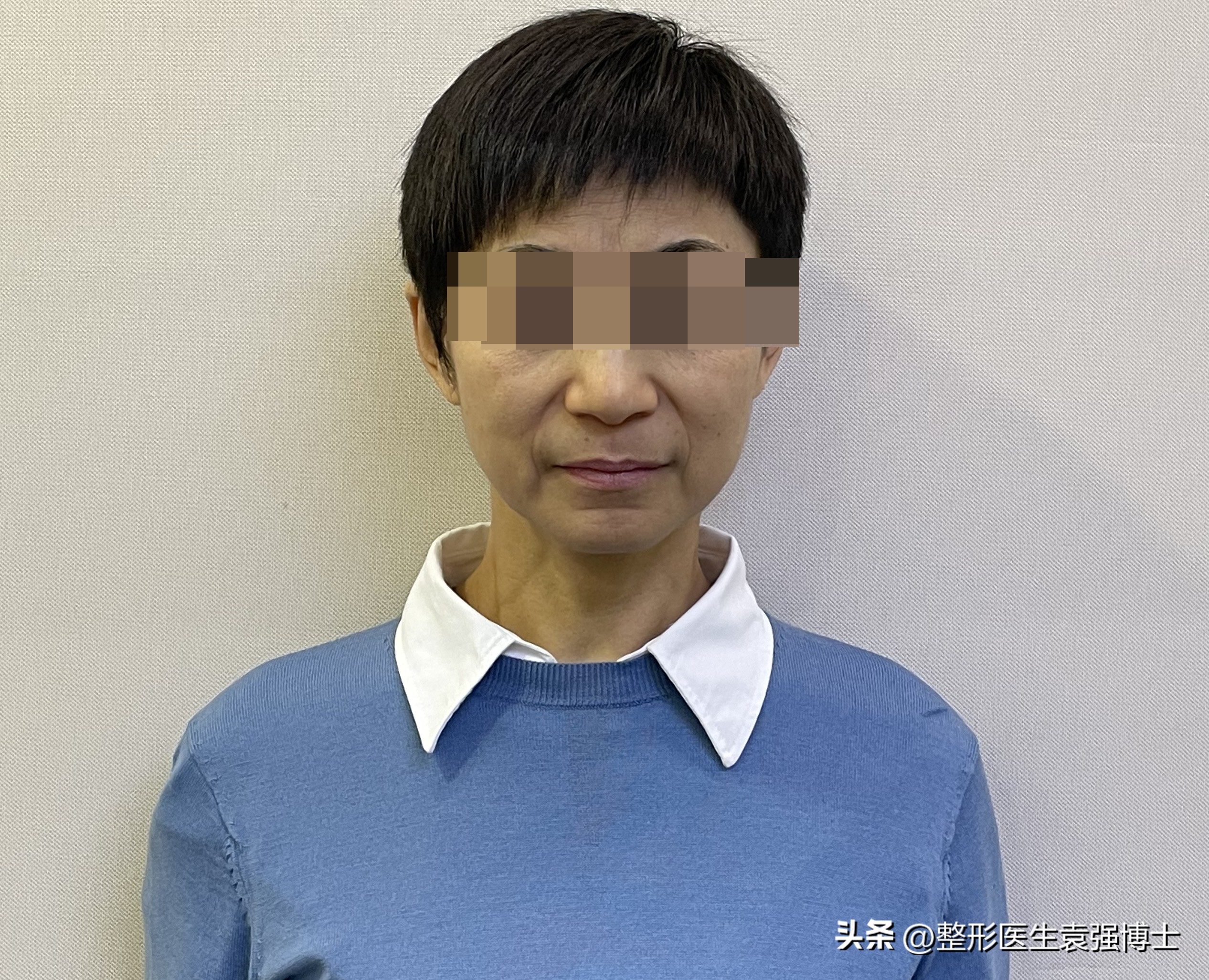 57岁脸又瘦又松，从广州来北京做大拉皮，即刻照镜子“没敢认”