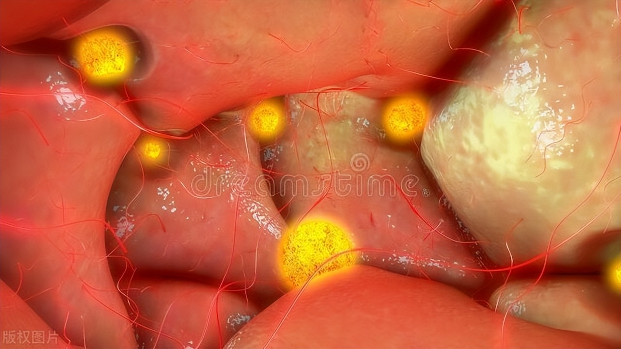 同居室友脚气致女友*处私**炎？*裤内**“豆腐渣”揭疑，医生揭晓谜团