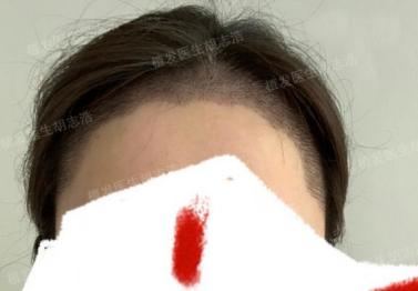 植发后后枕部的头发多久能恢复,植发3个月恢复图片