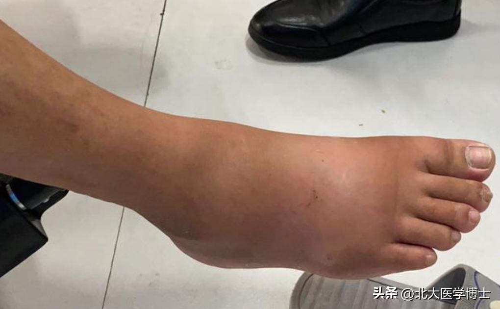 从中医的角度讲怎样理解痛风,痛风用中医治疗效果如何