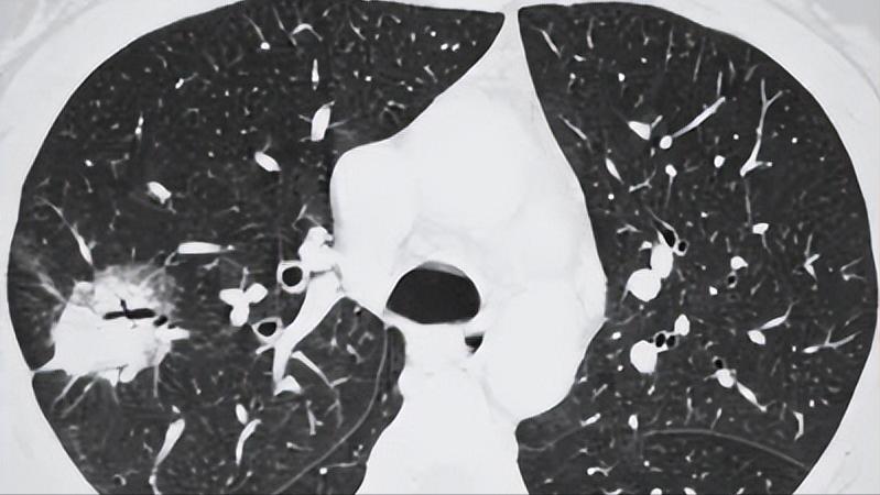 体检查出肺结节可以不调理吗,体检微小肺结节是什么