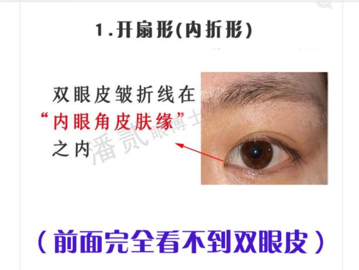 内眦赘皮用手术吗,内眼角内眦赘皮矫正不做手术