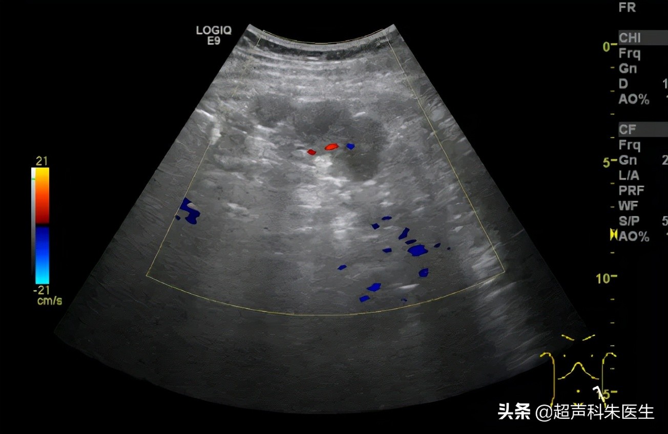 盆腔囊实性包块是恶性肿瘤的几率,盆腔左侧包块是肿瘤吗