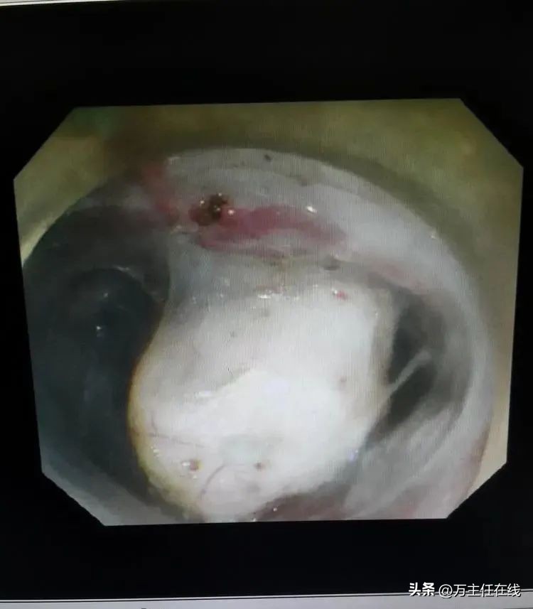 上海第一人民医院消化科万荣教授,消化内科专家手术