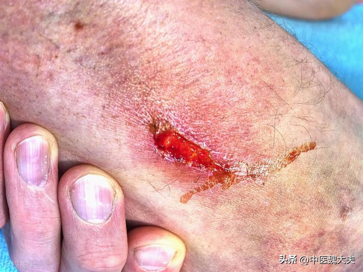 从炎症到癌症三种炎症别拖着,柳叶刀癌症治疗最新报告