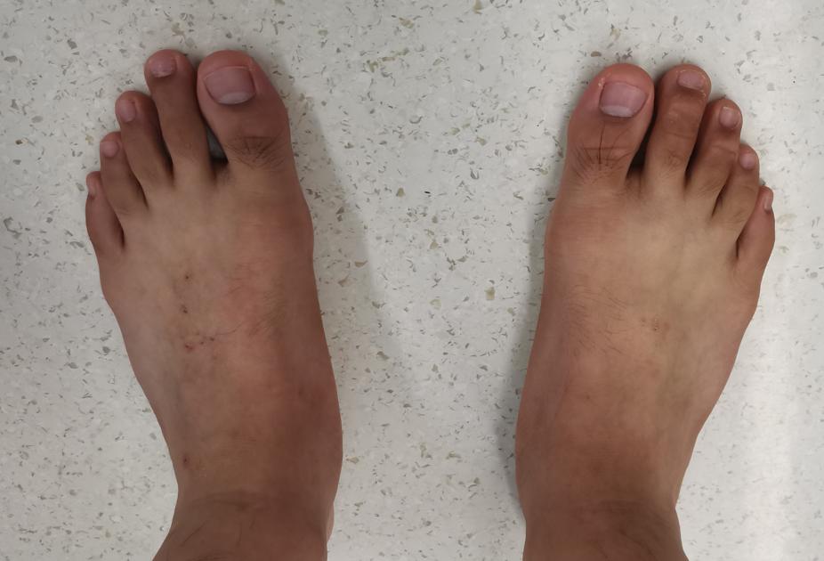 距下关节制动术成人效果如何,距下关节制动器作用