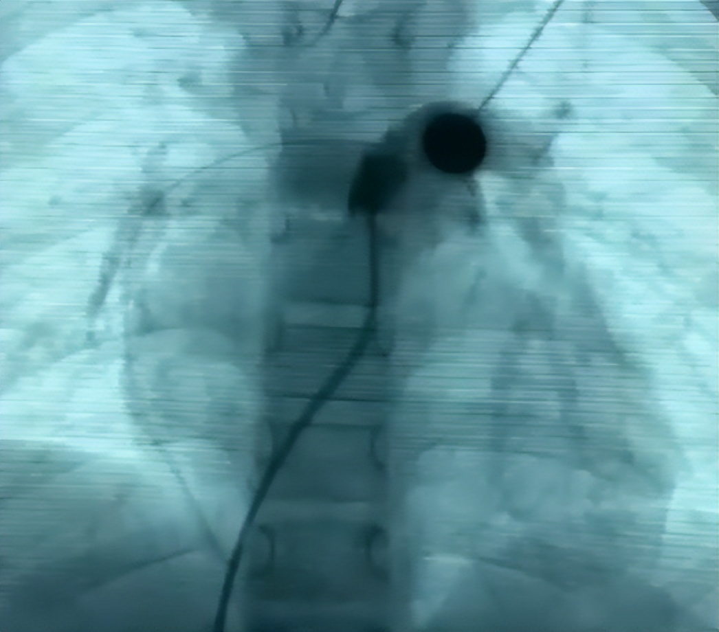 picc拔管遇导管断裂如何处理,picc导管断裂的影像表现