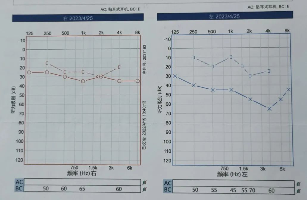 二阳后耳聋,二阳后耳聋能自愈吗