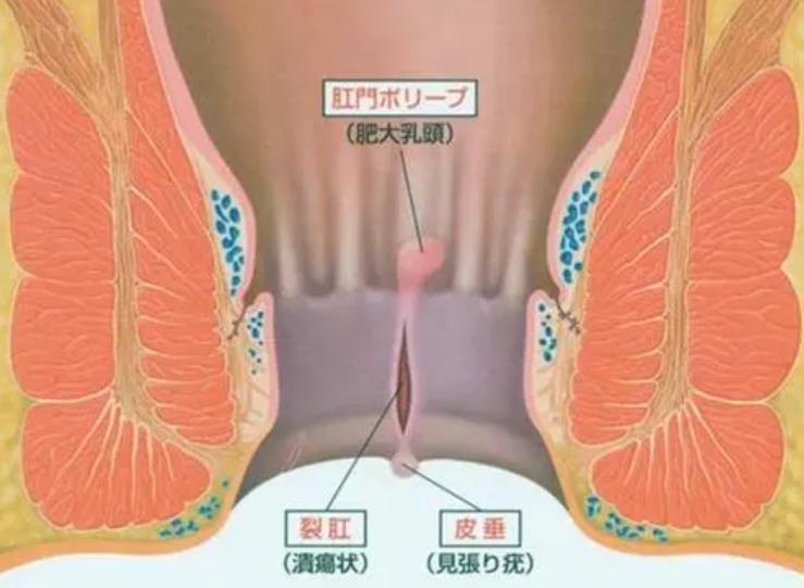 擦了大半辈子的屁股，竟然都擦错了！想要屁股健康，这4点要注意
