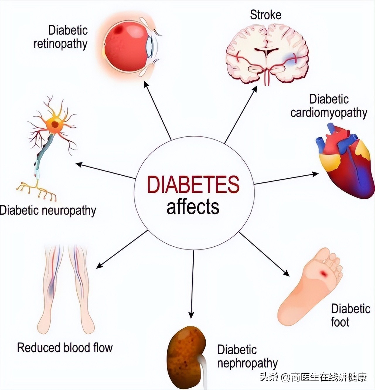 降糖药达格列净长期吃有什么害处,降糖药物达格列净有什么优势