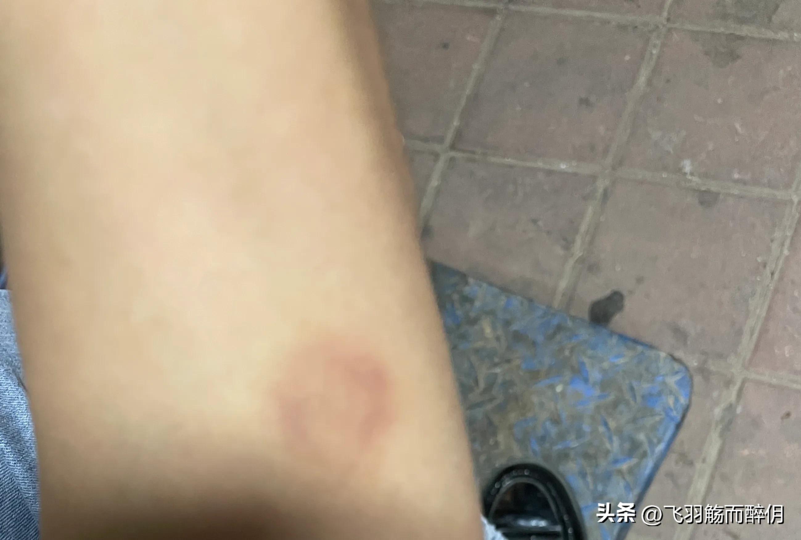 头上有包一按就疼还伴随头晕,头上长了疙瘩微痛偶尔头晕