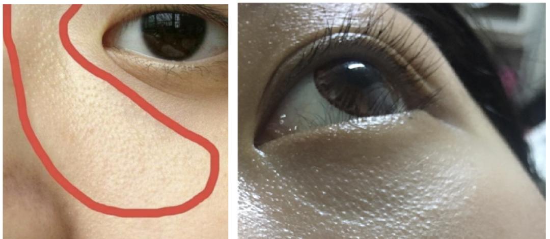 鼻子周围起疙瘩怎么回事,鼻子周围红肿起疙瘩吃什么药