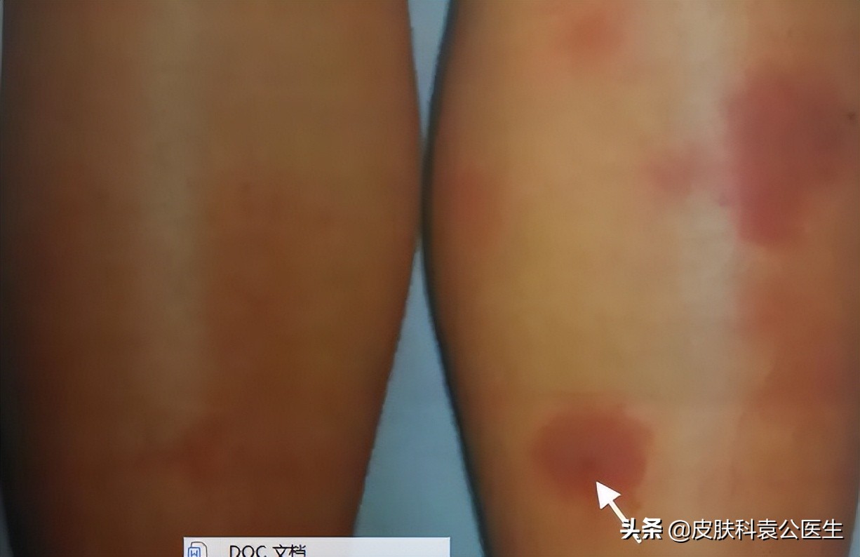 蚊虫叮咬引起的皮炎一年了没好,夏季有哪些虫叮咬会红肿