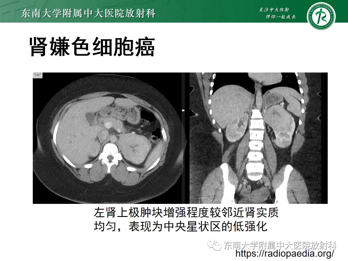 周利群谈肾嫌色细胞癌ct特点,好文分享值得深思