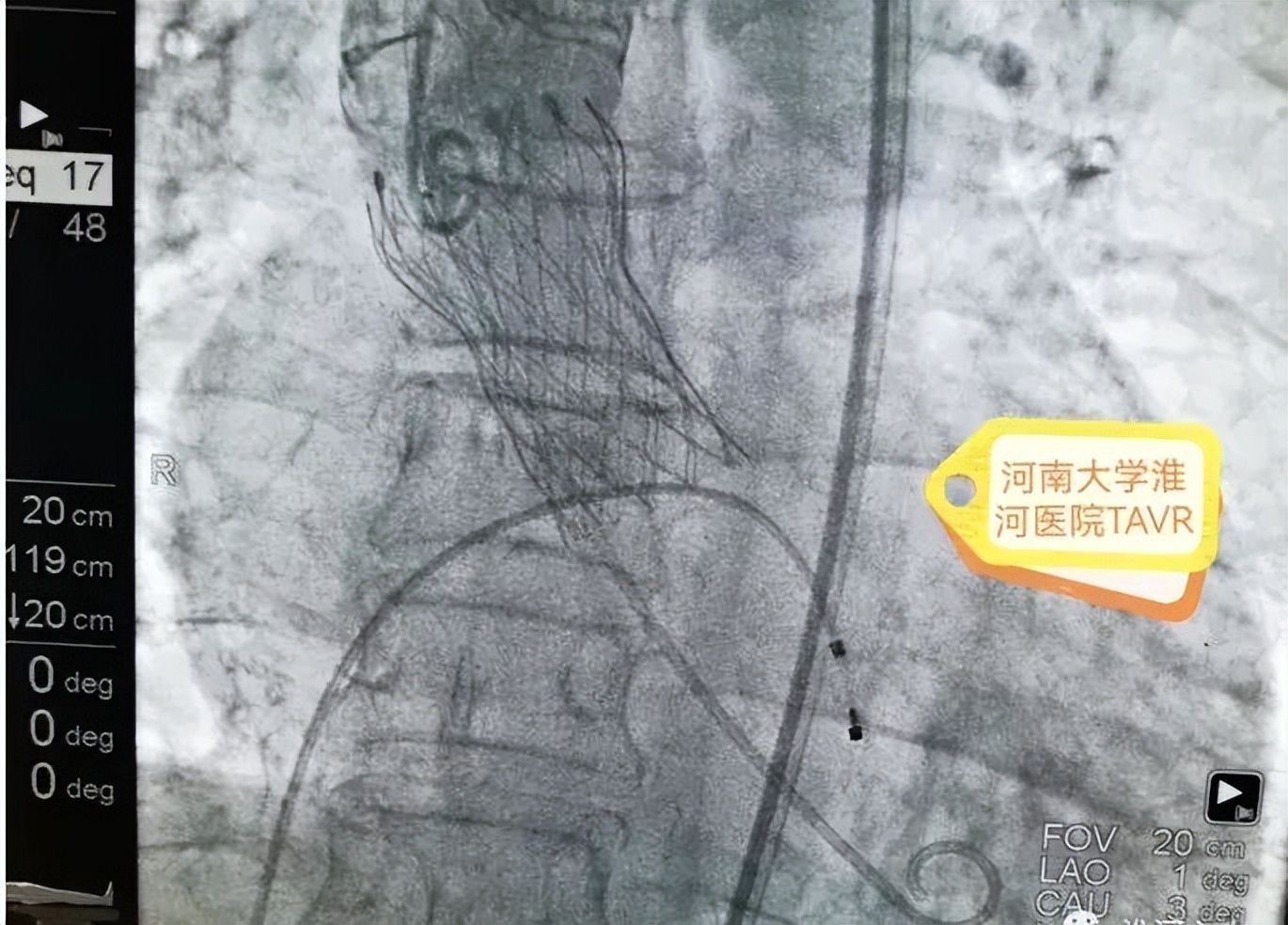 河南大学淮河医院顺利为一例二叶式主动脉瓣重度狭窄伴重度钙化的病人实施了经导管主动脉瓣置换术
