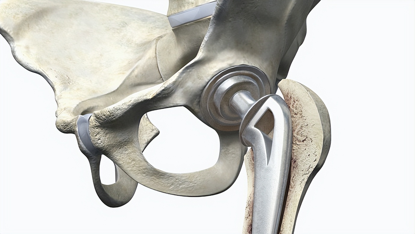 骨折后的并发症有哪些,骨折手术后需要注意哪些问题