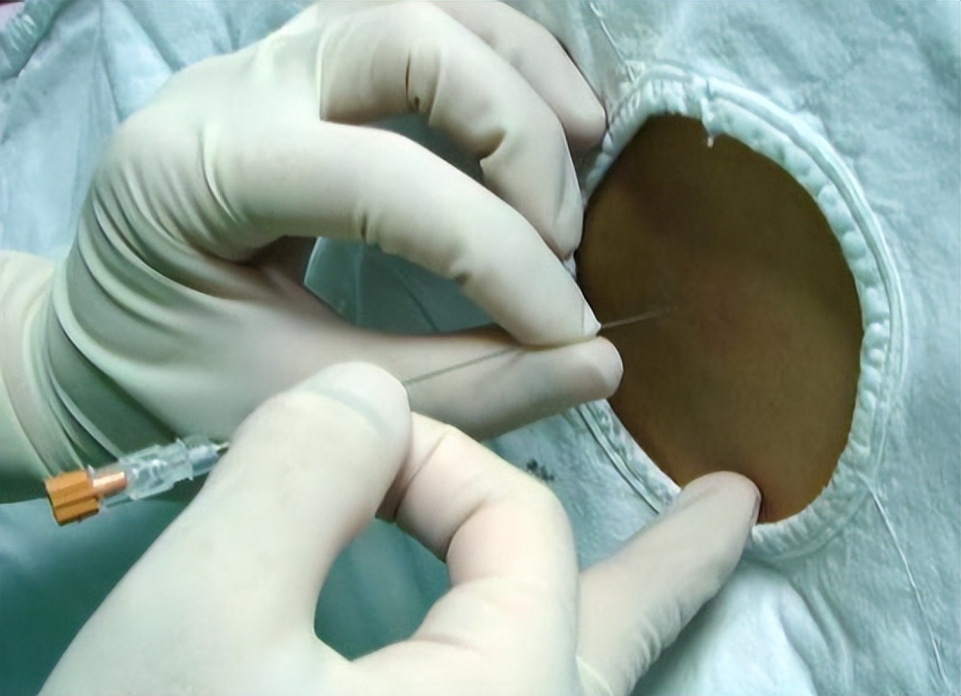 剖宫产手术，不同的全身麻醉方法有啥区别？对胎儿健康影响不同！