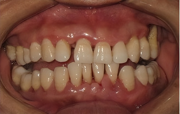 牙周炎治愈指南，这些口腔护理注意事项要牢记