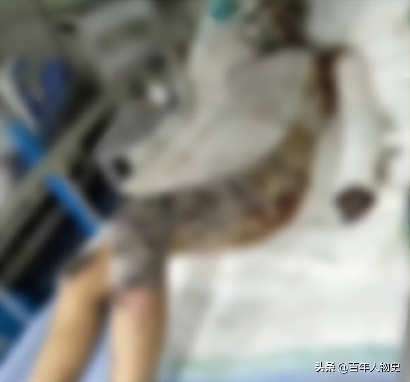 19年,四川20岁女孩遭大火毁容48%烧伤,双臂截肢如今怎么样了?