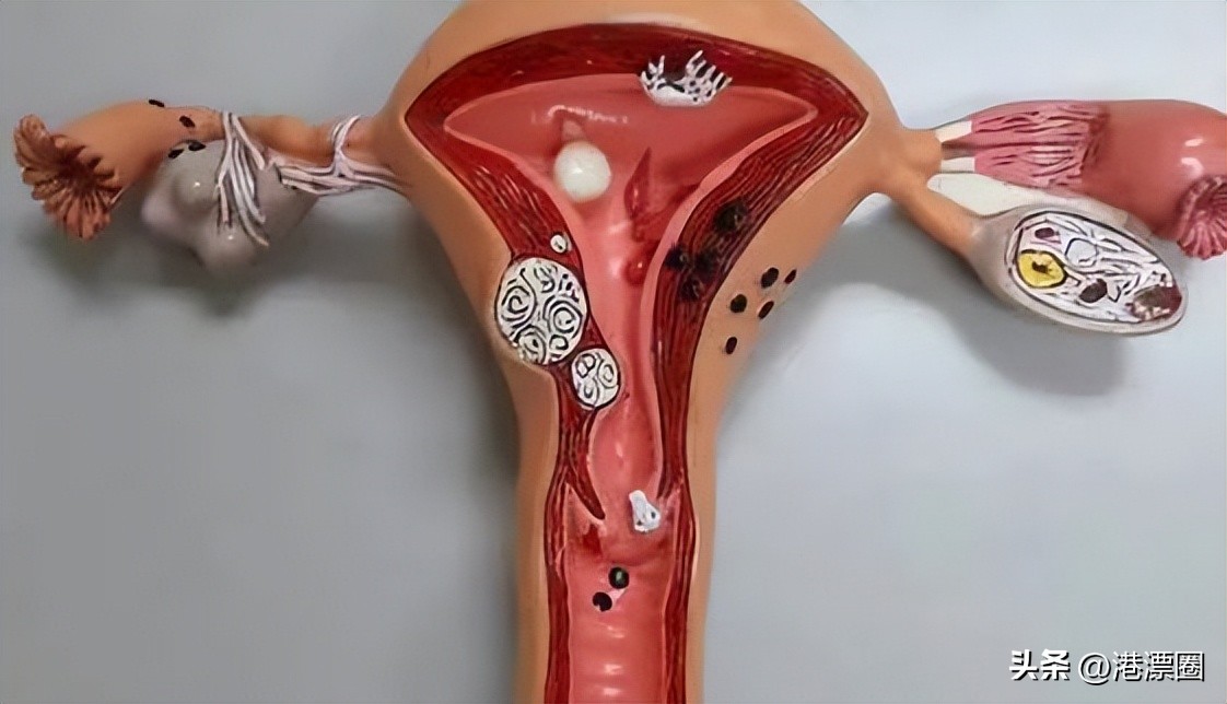 我堕胎4次以后还能怀孕么,香港女孩堕胎5次